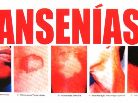 Especialista alerta para presen�a da Hansen�ase